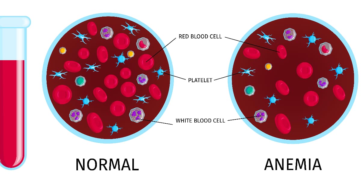 Anemia Home Test: Describe in subtleties